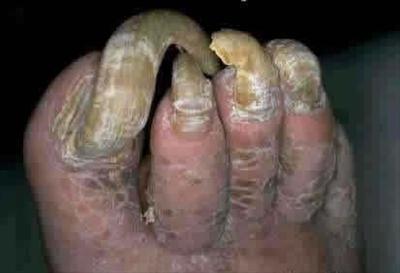 tonails