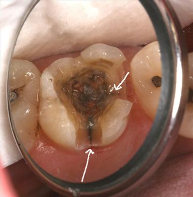 hobo's tooth