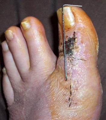 toe