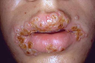 Herpes