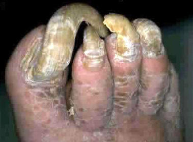 toe nails