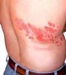 Herpes Zoster o 