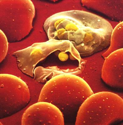 malaria