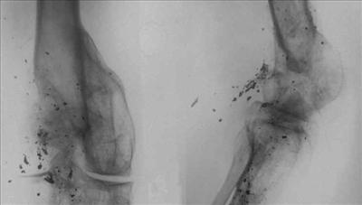 Bullet to the Knee