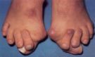 POSH'S BUNION