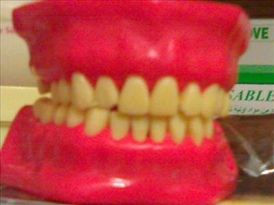 yellow denture