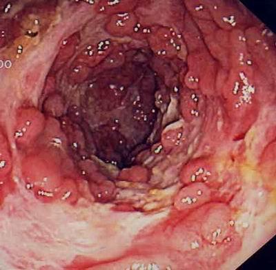 Chrons Disease