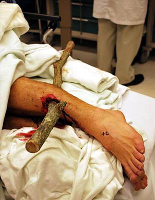 Stick in Leg