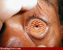 Lamprey Disease 