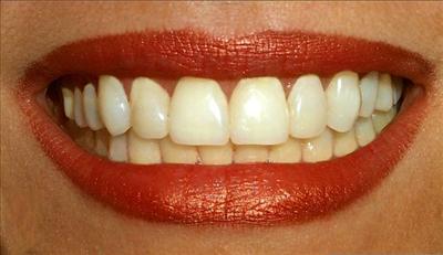 Tooth.