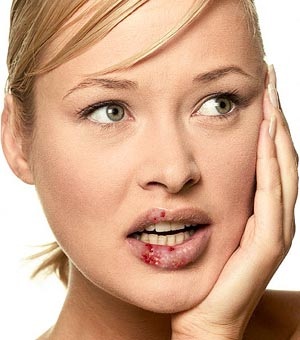 bout with herpes simplex 1