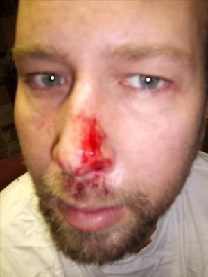 bloody nose