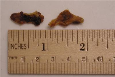 Ear Wax