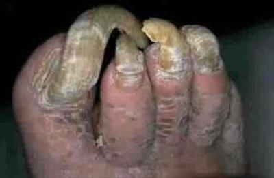 Toe Jam