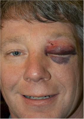black eye