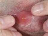 boils4