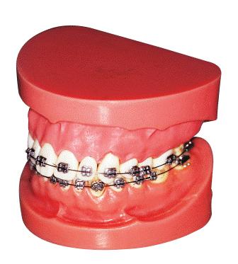TRAIN TRACK BRACES