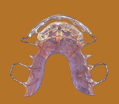 RETAINER BRACES