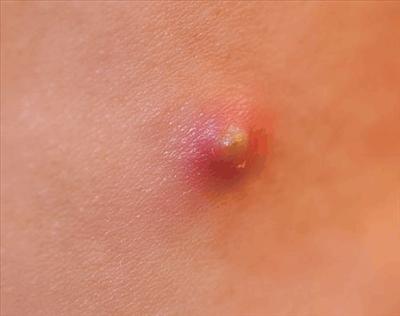 Pimples!