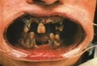 nasty teeth