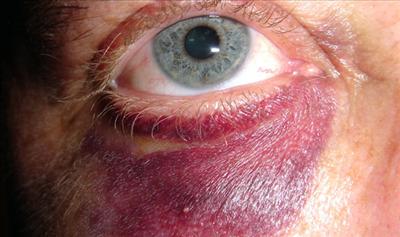 black eye
