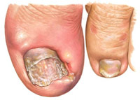 un ongle incarné