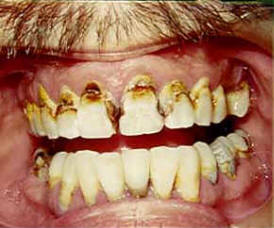 des caries