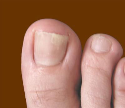 toe