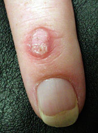 wart