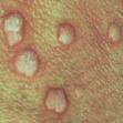 nasty case of genital warts