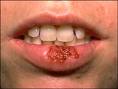 herpes sore