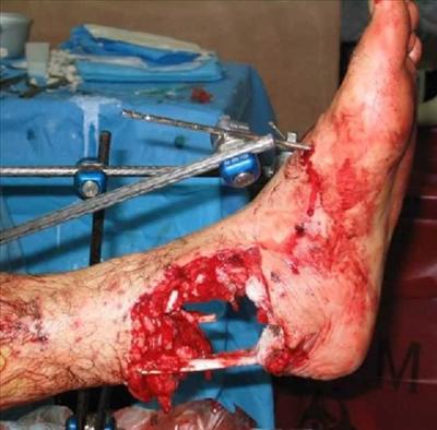 Bullet in leg