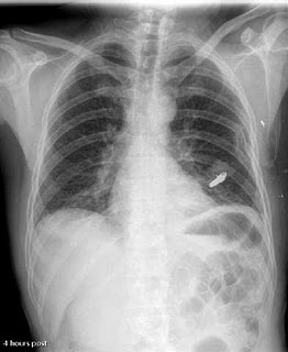 Bullet in chest
