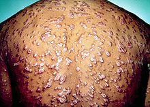 Box of Syphilis