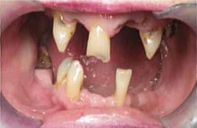 Meth Mouth