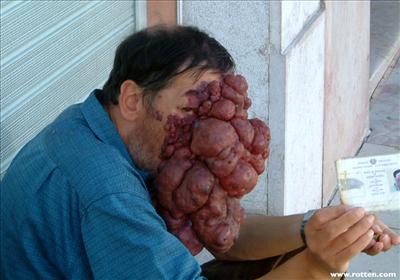 Disease