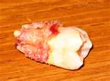 Tooth