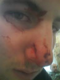 Broken Nose