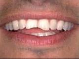 Broken Teeth