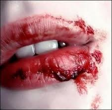 Bloody Lip