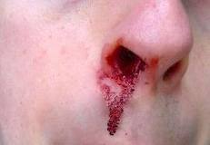 Bloody Nose