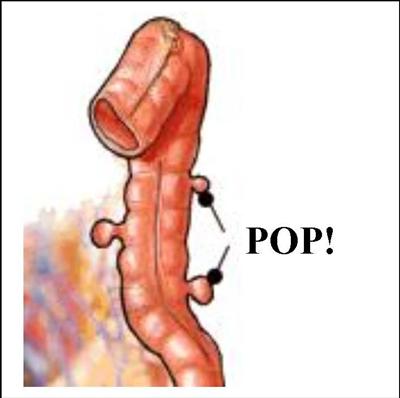 Diverticolo che si forma