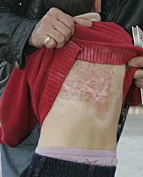 CICATRICE CICATRIZZANTE DA PARCO ACQUATICO IN ALTERNATIVA AL TATUAGGIO from PalmaCicatrice indelebile da kamikaze offerta da...Carla