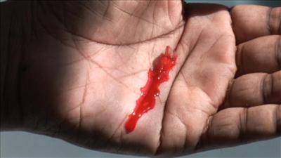 Control bleeding to the palm of the hand