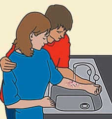 Use St. Johns to treat a burn