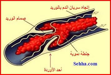 الجلطات 